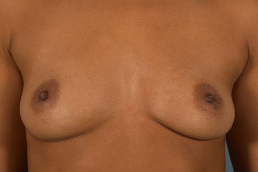 After Breast Augmentation | Patient 1