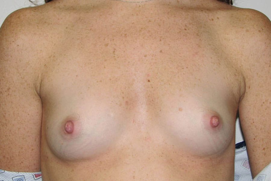 After Breast Augmentation | Patient 3