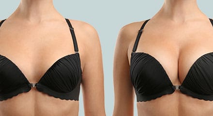 Breast Augmentation