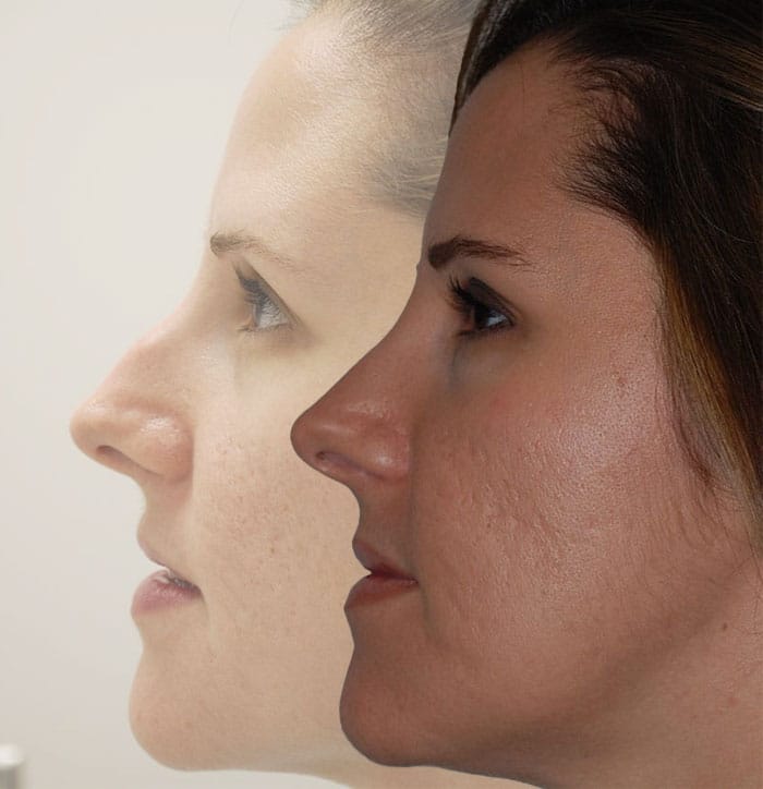 Rhinoplasty Before & After | Patient 1