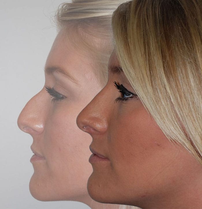 Rhinoplasty Before & After | Patient 3