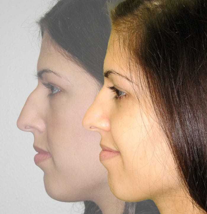 Rhinoplasty Before & After | Patient 4