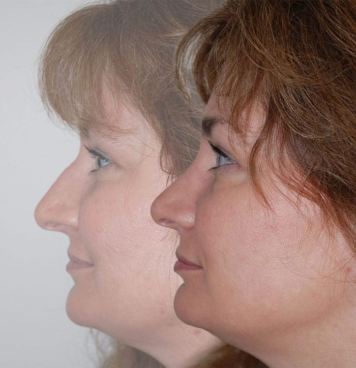 Rhinoplasty Before & After | Patient 5
