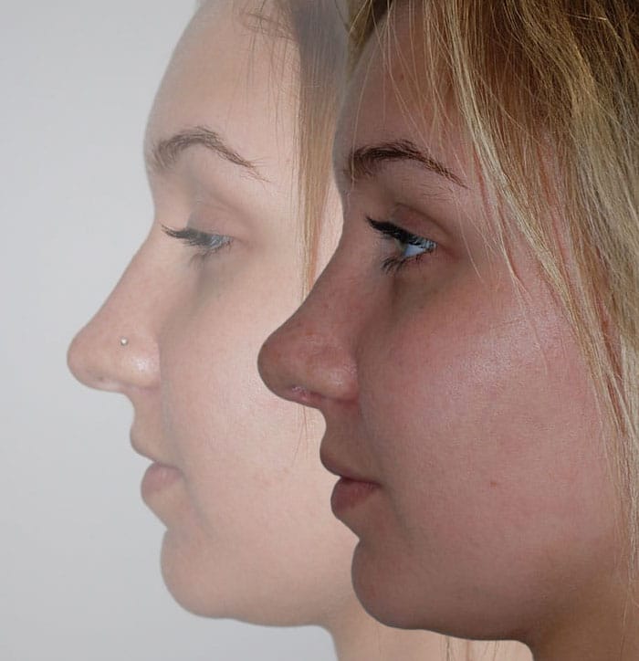 Rhinoplasty Before & After | Patient 6