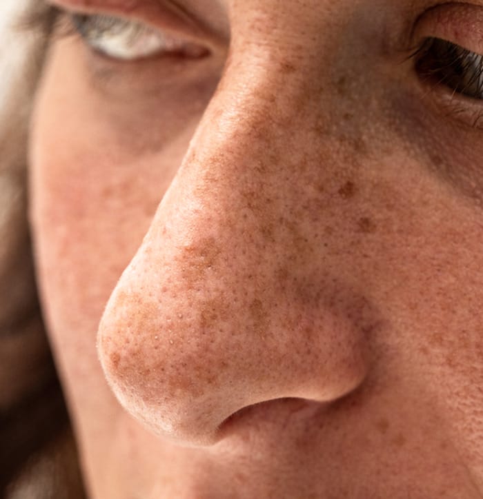 How Sun Damages Skin