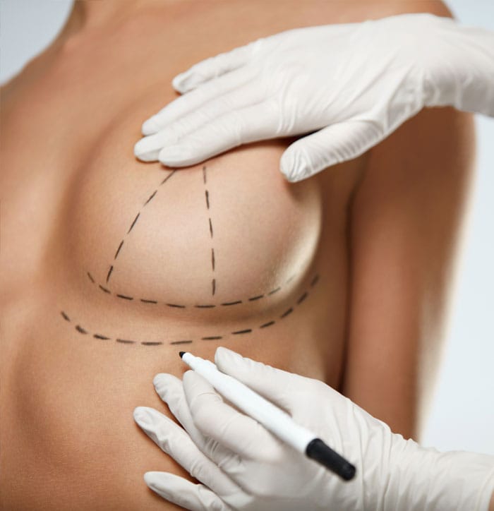 Through a breast lift (mastopexy), Dr. Houser or Dr. Kraft will help restore your breasts to the shape and position that feels most comfortable, appropriate, and desirable to you.