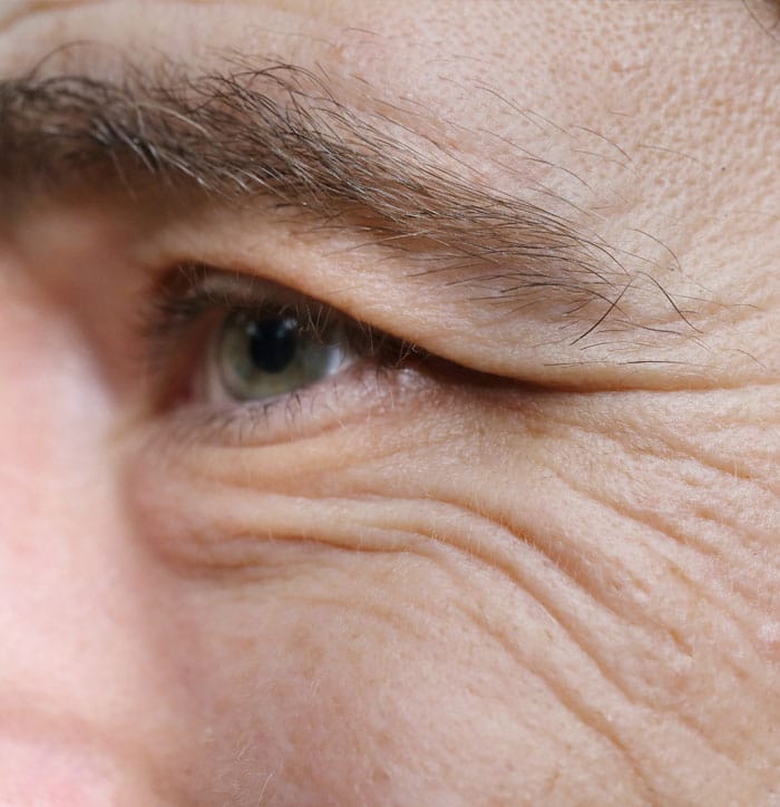 Upper Eyelid Surgery