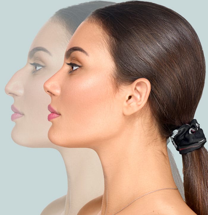 Rhinoplasty