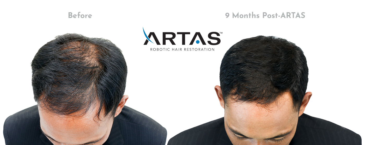 ARTAS Hair Studio—a 3D photograph-based simulation of your potential procedure results.