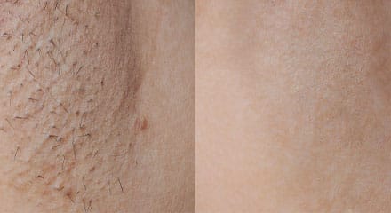 How long does it take to see laser results?
