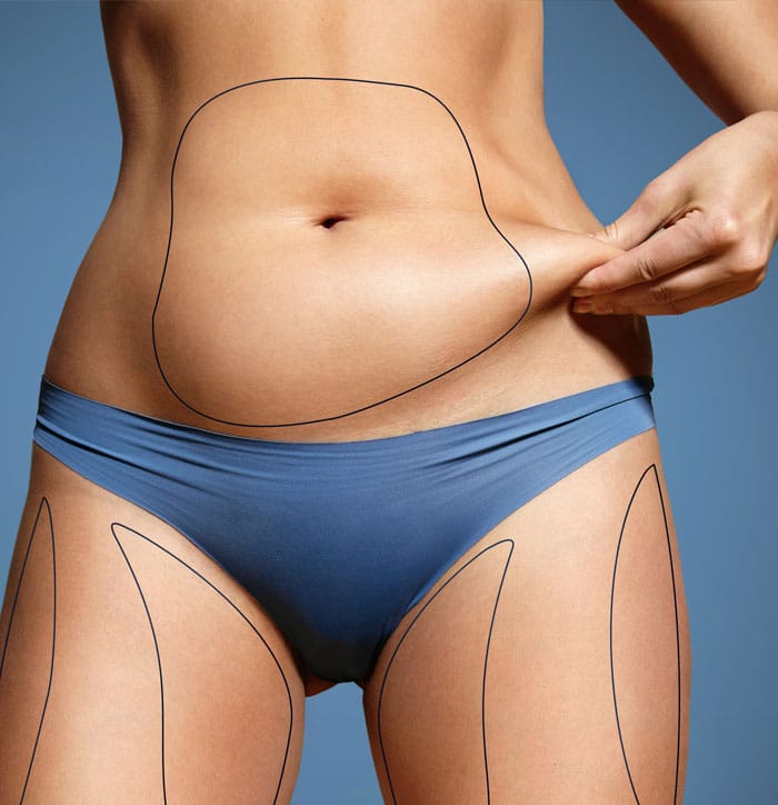 Liposuction Treatment Areas