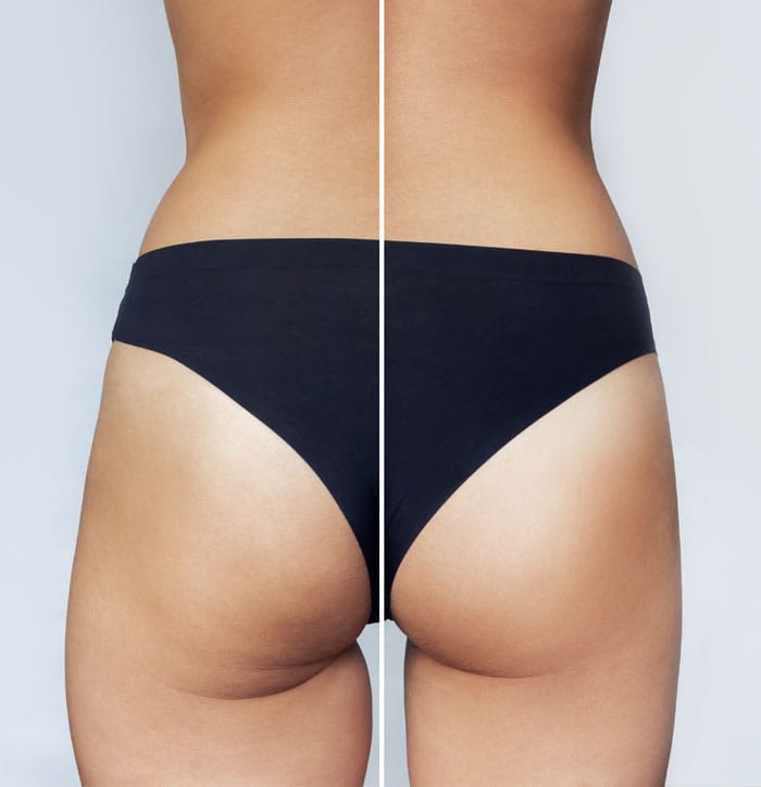 The thigh lift procedure: what to expect