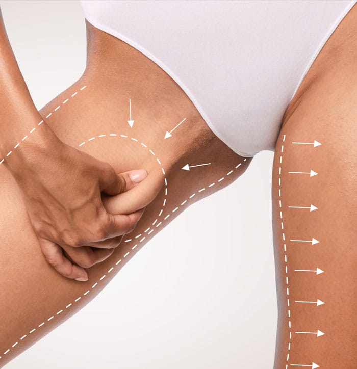Thigh lift surgery: what is it?