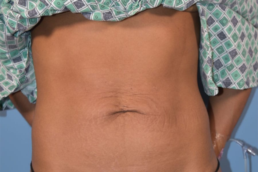After Tummy Tuck | Patient 1