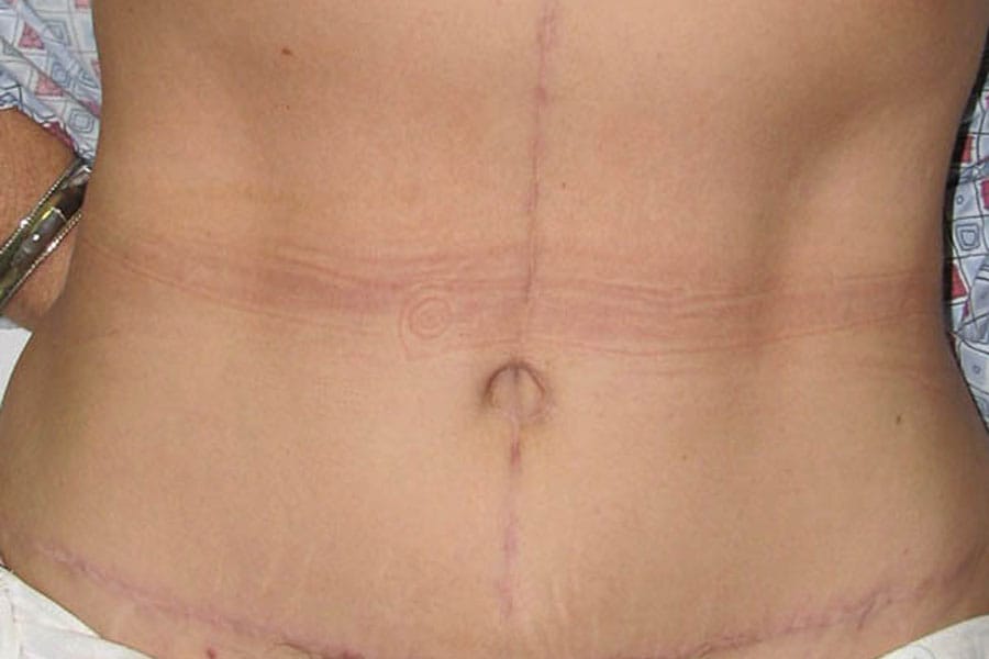 After Tummy Tuck | Patient 2