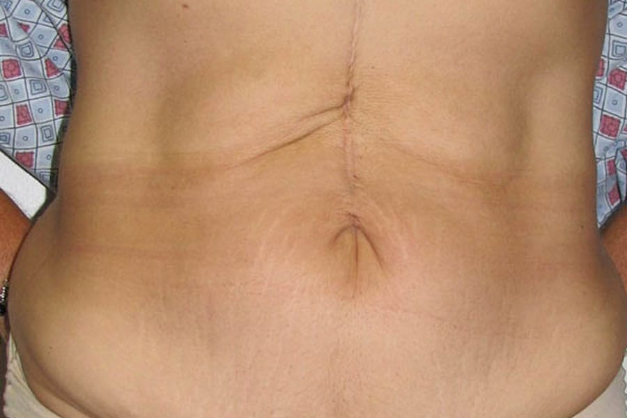 After Tummy Tuck | Patient 2