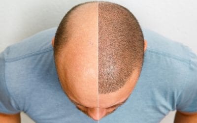 Natural Results with Hair Transplant