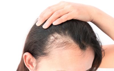 Understanding Hair Loss: Causes, Concerns, and How ARTAS Robotic Hair Transplant Can Help