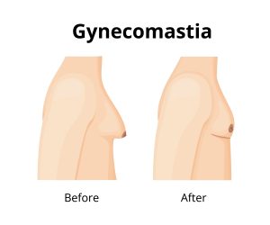 Why More Men in Columbus Are Choosing Gynecomastia Surgery and Hair Restoration