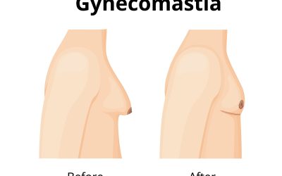 Why More Men in Columbus Are Choosing Gynecomastia Surgery and Hair Restoration