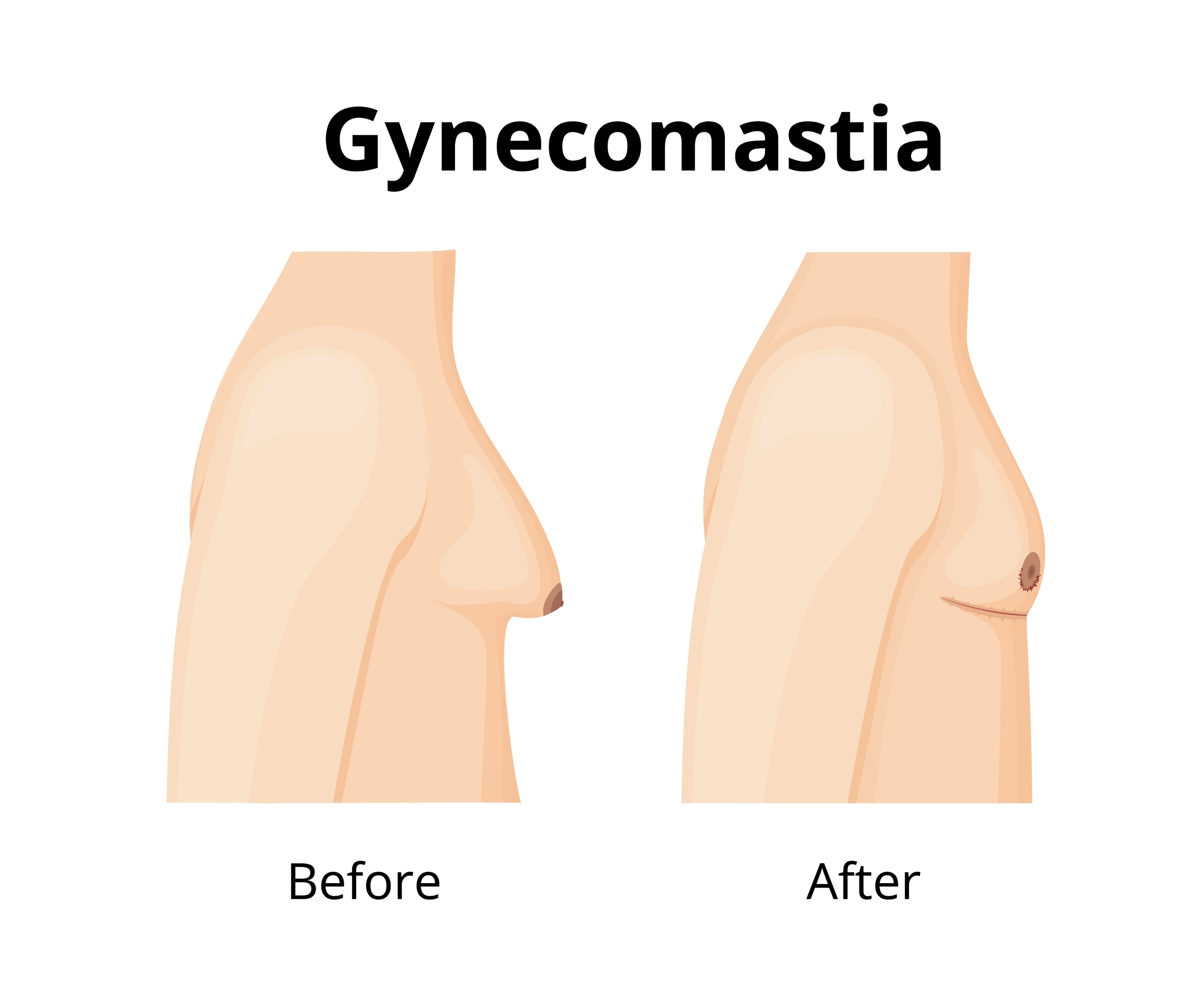 Why More Men in Columbus Are Choosing Gynecomastia Surgery and Hair Restoration Why More Men in Columbus Are Choosing Gynecomastia Surgery and Hair Restoration