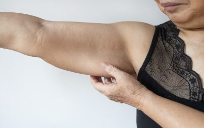 Why Skin Doesn’t Bounce Back: Arm and Thigh Skin Laxity Explained