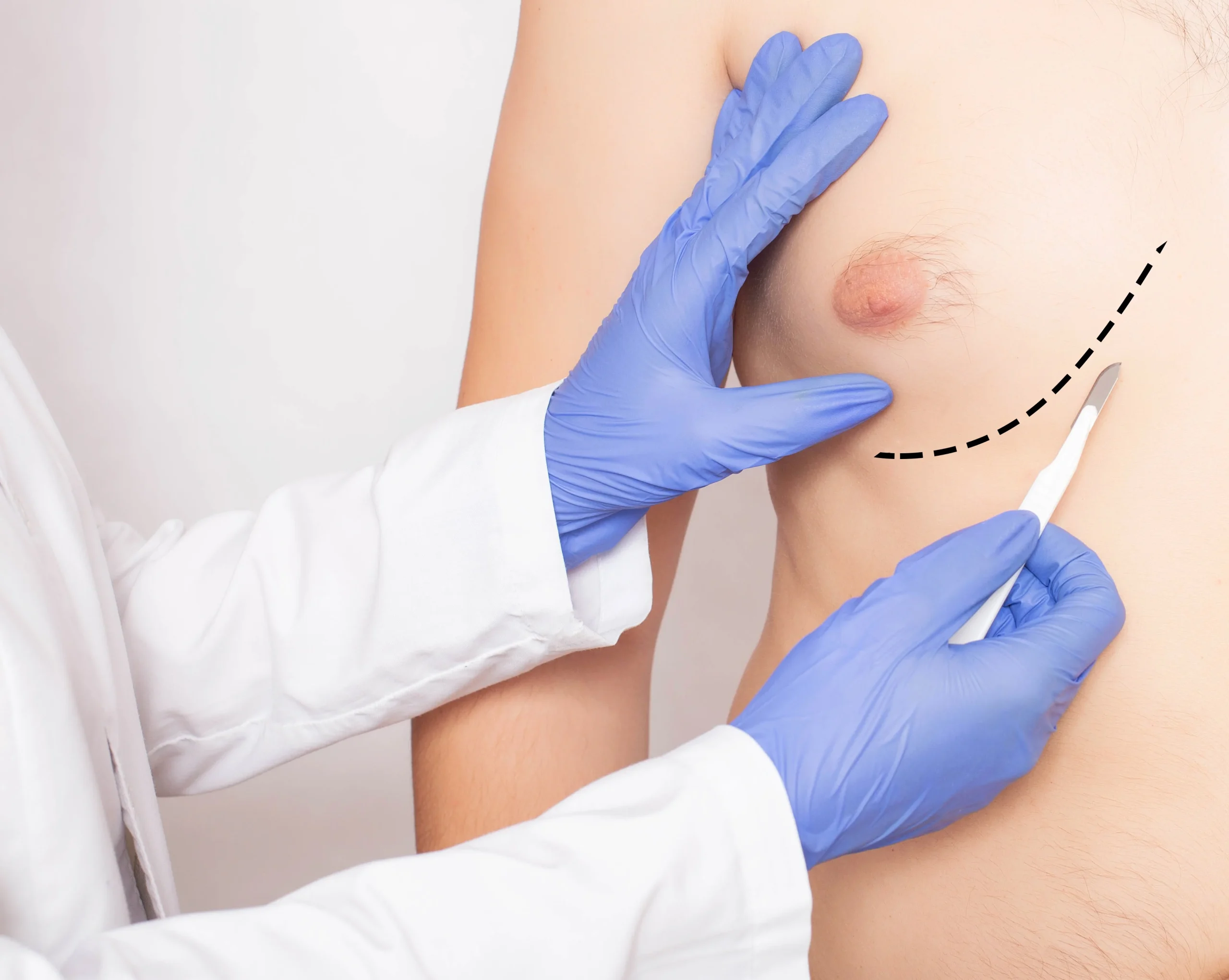 shutterstock_1827455333 Understanding Gynecomastia: Causes and Symptoms