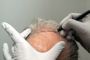 Hair Transplant Planning for Men: Smart, Long-Term Choices for Restoring Your Hair