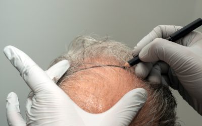 Hair Transplant Planning for Men: Smart, Long-Term Choices for Restoring Your Hair